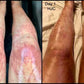 Before and after pictures of scarred legs that have healed in a week's time using Platinum Rose aftercare