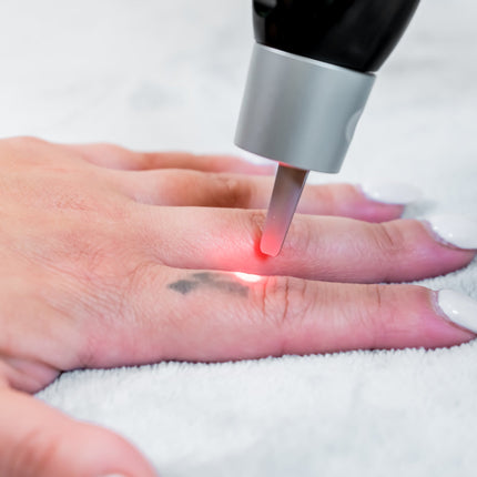 Bright red laser light zapping a small, faded tattoo on the side of a finger.