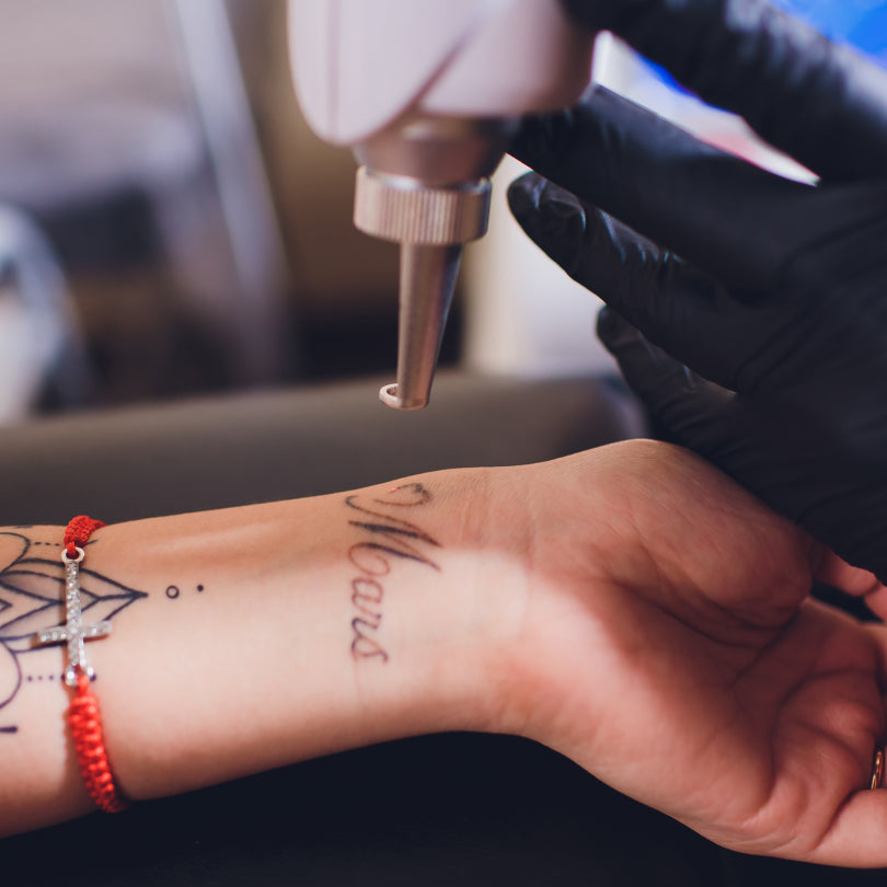 Close-up of a black-gloved hand using a laser to remove a "Mars" script tattoo from a person's wrist. Does Laser Tattoo Removal Really Work?