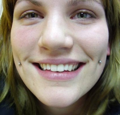 Dimple Piercing Pictures|Cheek Piercing Pictures|One Cheek Piercing