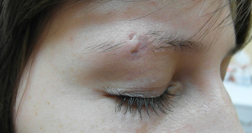 Eyebrow Piercing Scar