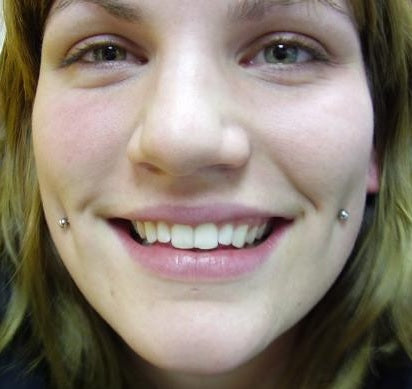 Cheek Piercings by Cornelius|Lymph Around a Healing Piercing | Piercing Crusties|Picture of Swollen Cheek Piercings From Community.livejournal.com Cheek Piercing Aftercare