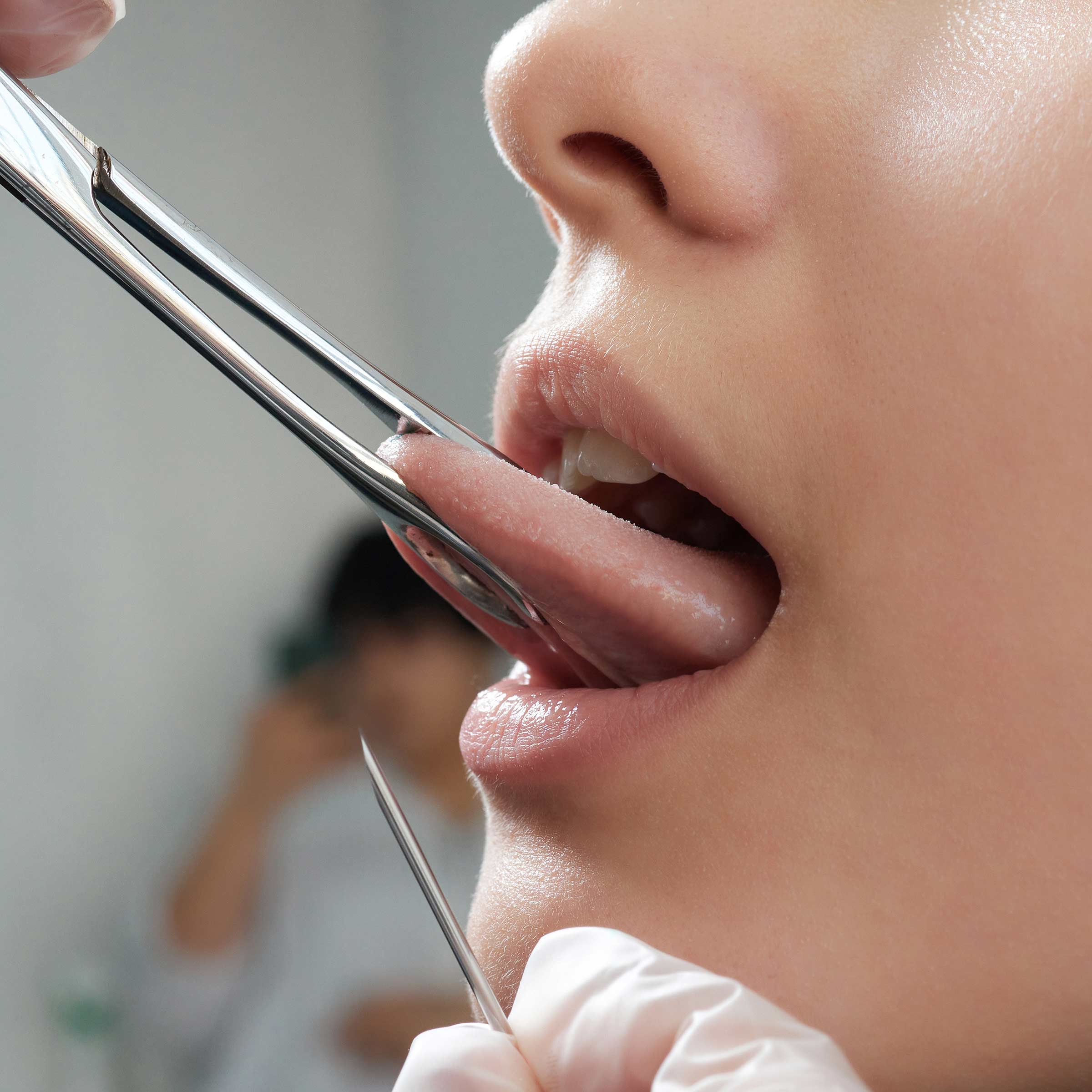 Piercing client with tongue clamped by forceps for tongue piercing