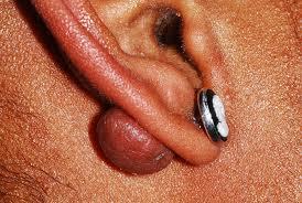 side view of keloid scar on earlobe piercing