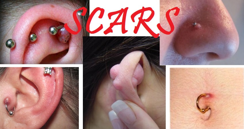 Body Piercing Scars: Keloids, Hypertrophic Scars & Atrophic Scars Identifying & Minimizing Body Piercing Scars