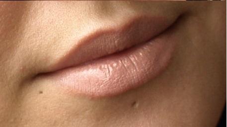Photo of mouth with piercing scars Is Silicone Gel Effective for Treating Piercing Scars?