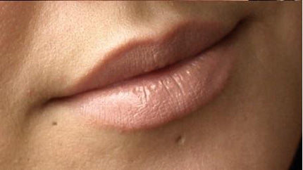 Photo of mouth with piercing scars