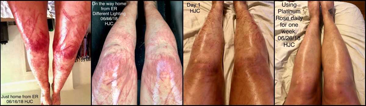 Before and after pictures of scarred legs that have healed in a week's time using Platinum Rose aftercare