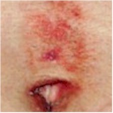 Piercing Allergies