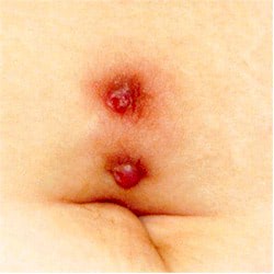 Hypertrophic Scar Picture