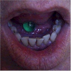 Tooth Issues From Tongue Piercings