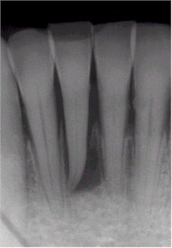X-Ray of Tooth Issues From Tongue Piercings
